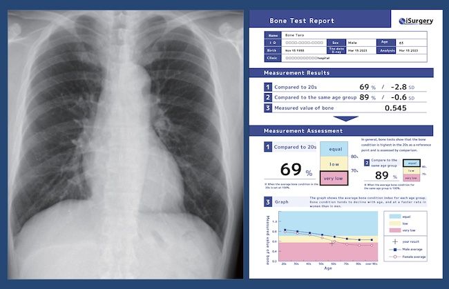 Fujitsu and iSurgery launch bone health promotion project in Japan with Jikei University School of Medicine aiming for early detection of osteoporosis